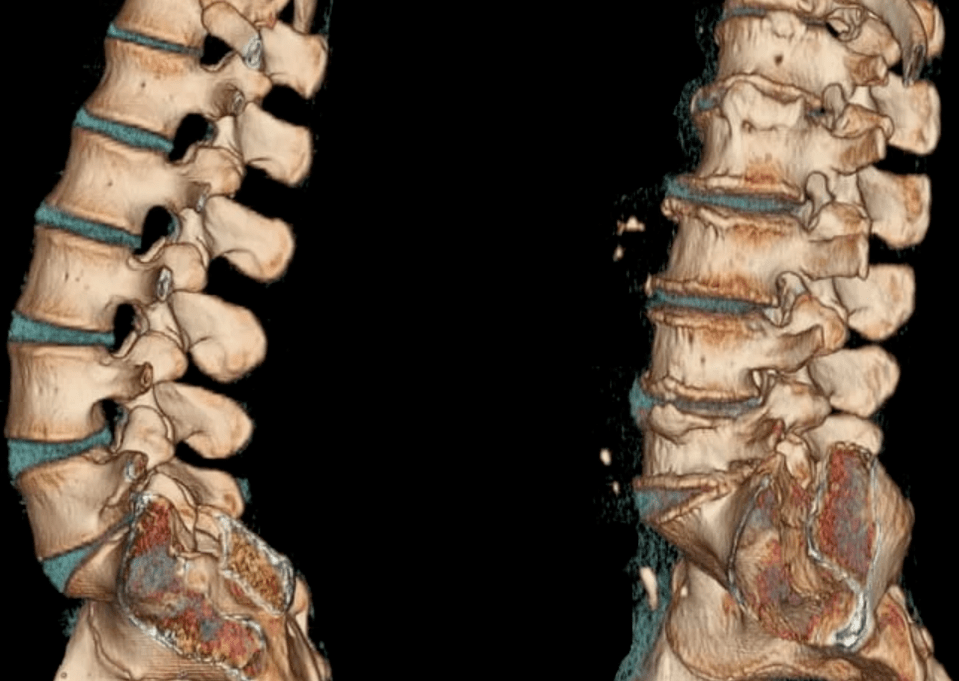 osteochondrosis