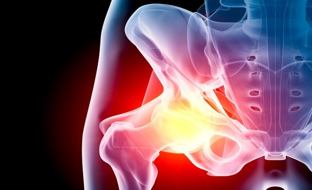 arthrosis nke nkwonkwo hip