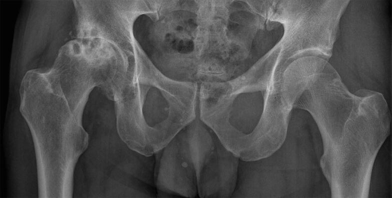 Na-emebi arthrosis nke nkwonkwo hip na x-ray