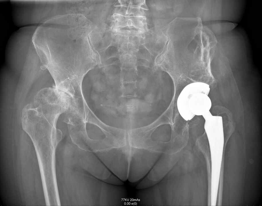 X-ray nke nkwonkwo hip mgbe arthroplasty