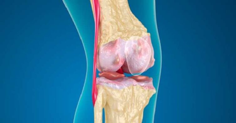 Ọrịa ogbu na nkwonkwo ụkwụ, nke na-akpata mbibi Cartilage na nkwonkwo