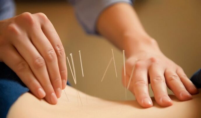 acupuncture iji gwọọ mgbu azụ dị ala