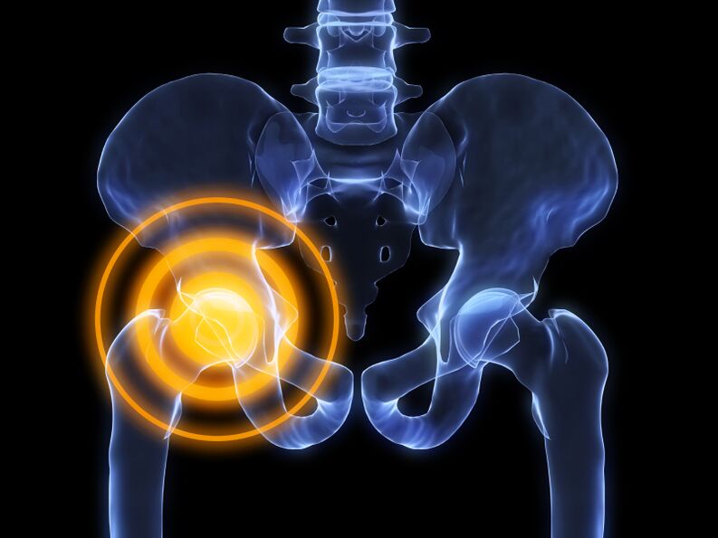 arthrosis nke nkwonkwo hip