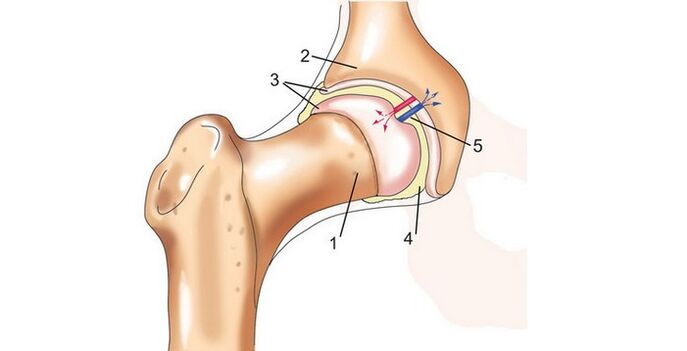 nkwonkwo hip na arthrosis